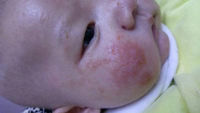 宝妈容易长痱子,宝妈长痱子