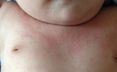 宝妈容易长痱子,宝妈长痱子