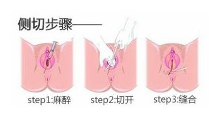 孕妈都怕的分娩侧切如何才能避免,孕妇顺产撕裂和侧切后注意什么