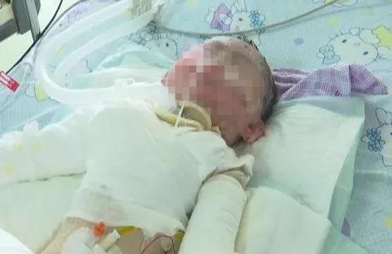 女孩被100度开水烫伤怎么办,女孩掉进汤锅烫伤