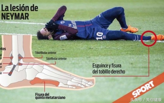 内马尔回应在世界杯受伤,内马尔伤退医学科普