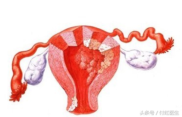 血性白带是宫颈癌吗,血性白带是癌的可能性大吗