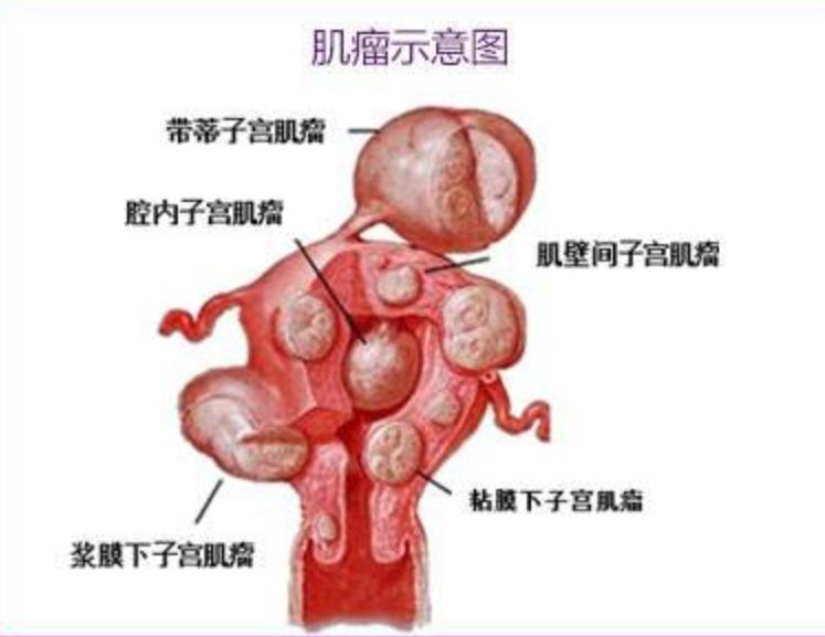 海扶刀治疗直径多大的肿瘤,海扶刀手术打不打麻药