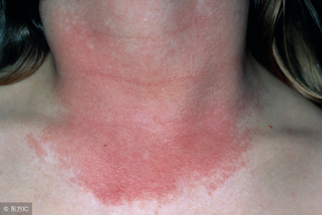 夏季皮炎为什么每年犯如何根除,夏季皮炎不能流汗吗