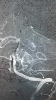 与死神角力！景德镇市一院卒中中心成功挽救一名急性脑梗死患者