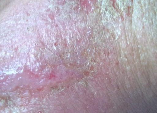 夏天皮肤湿疹怎么治除根,夏季皮肤湿疹有什么特效药