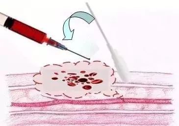 抽血后淤青鼓包疼痛怎么处理,抽血没有按压好淤青严重吗