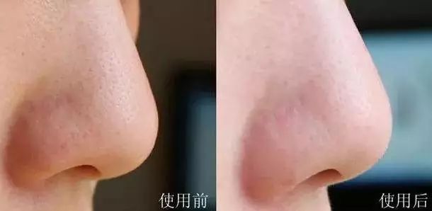 好物去黑头祛痘,去黑头粉刺面霜