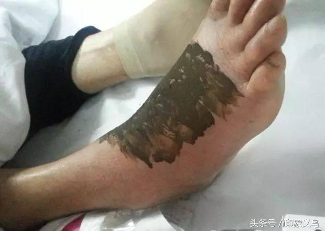 小孩被毒蜘蛛咬伤,小男孩被蜘蛛咬伤了