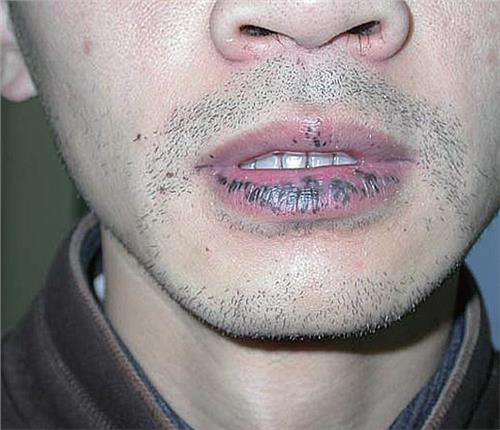 嘴唇上出现黑斑与肠胃疾病,下嘴唇上有黑斑就是胃有问题吗