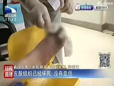 女儿用84消毒液给母亲治脚气,致其脚趾破溃只能截掉!