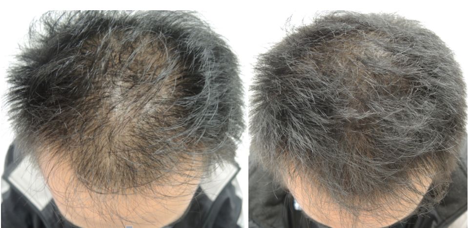 脱发、发际线高、地中海的克星！用它，1个月头发不掉了，不痒了，半年变浓密