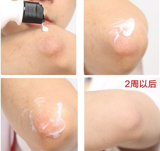 PP、腋下、手肘、三角区发黑暗沉?日本女*爱性**用好物,抹一抹,4周白嫩如少女!