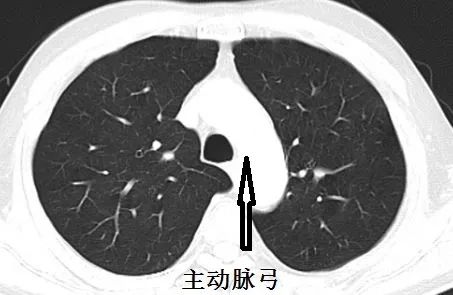 这样的气胸不少见,胸腔穿刺需谨慎!