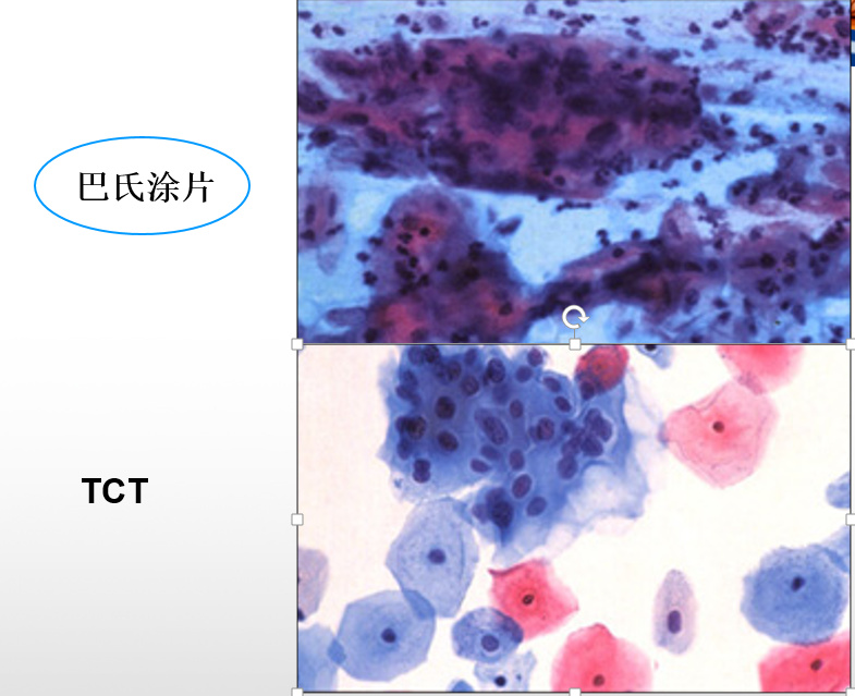 预防宫颈癌方法,预防宫颈癌最有效方法