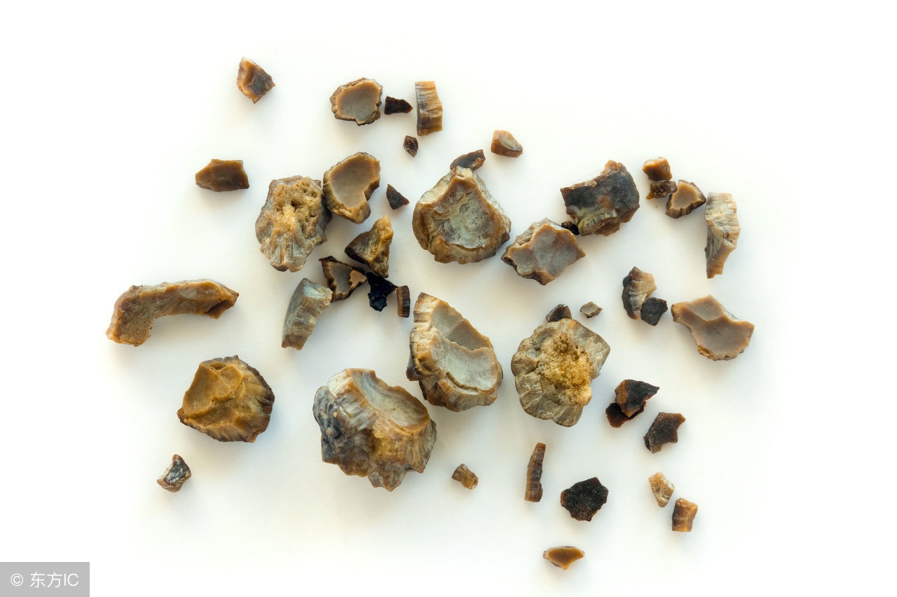 细说肾结石的病因都有哪些,肾结石传言全集