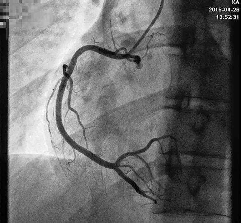 发作性胸痛心电图正常,心电图轻度T波改变图片