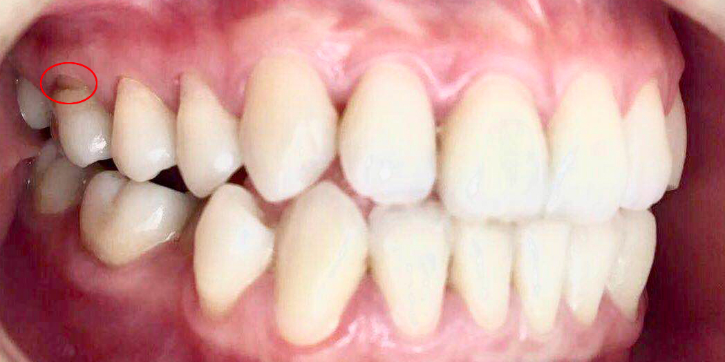 银汞合金——口腔界的“诺基亚”