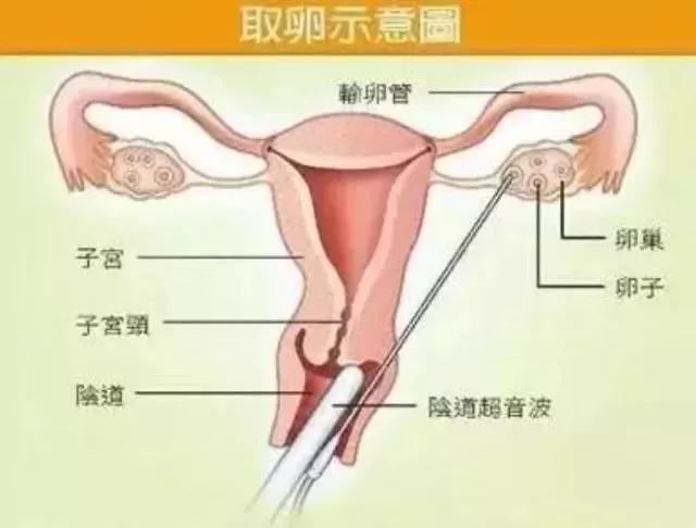 捐卵有多可怕？多少年轻女孩差点把命都搭进去了！