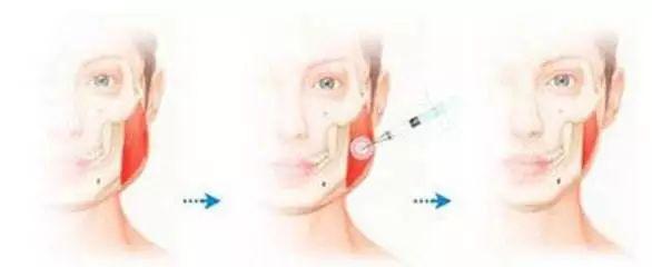 瘦脸针到底该不该打瘦脸干货快get,明星瘦脸针的正确方法