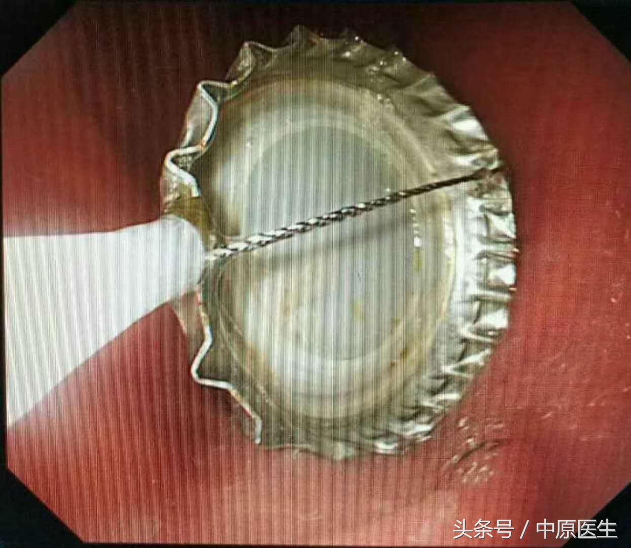 让人脑洞大开的“套套”用法：专家把男子喝到胃里的啤酒盖取出