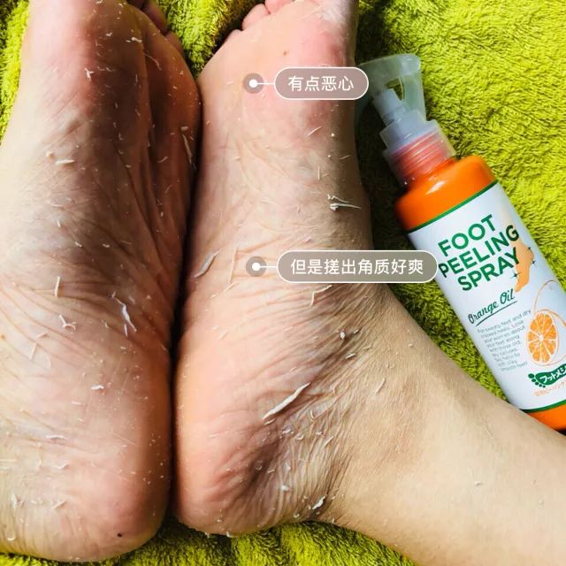 擦掉一张皮，双脚换皮术！死皮、老茧一喷就没，15秒还原嫩白玉足！