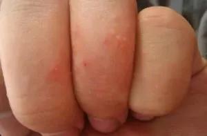 一到夏天脚上总起水泡,一到夏天脚上就长水泡是湿气重么