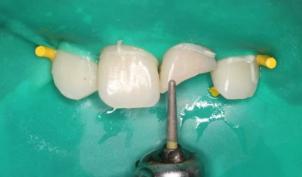 怎么拯救牙齿最快最有效,如何拯救牙齿