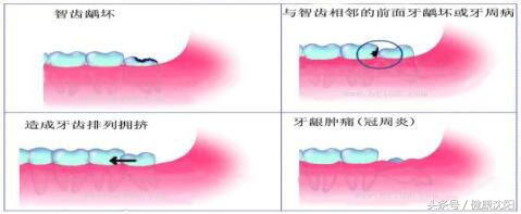 拔牙注意事项科普演讲,聊聊拔牙的那些事儿术后饮食篇