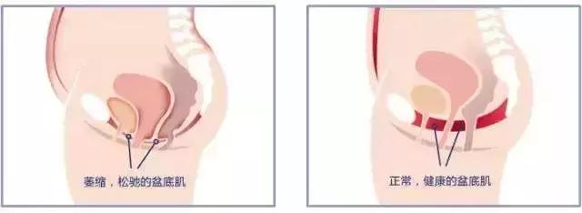 29岁女士竟然尿湿裤子，专家说我国有三成女性患有此病！