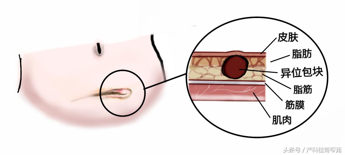 剖宫产后子宫内膜异位症,剖腹产后子宫内膜异位症注意事项