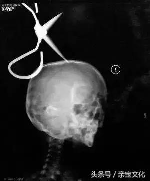 女童2岁一直吐怎么解决,2岁小孩一天吐了五六次咋回事