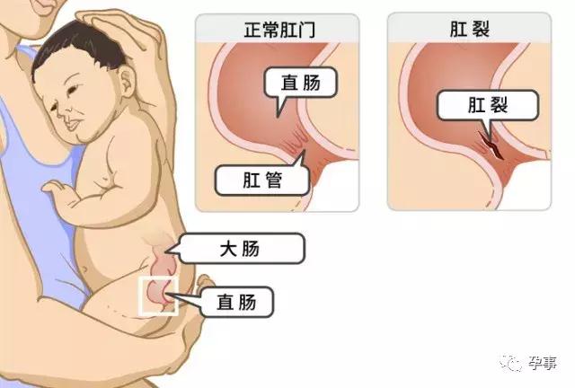 三个月的宝宝大便带血怎么回事,3个月宝宝便便带血怎么回事