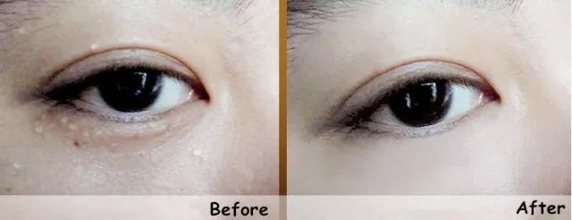 不用针挑手指扎进刺了怎么办,不用针挑就能挑出刺的方法