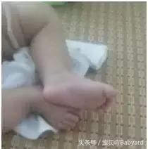 宝宝斜颈治疗方法视频,宝宝斜颈怎么纠正图解