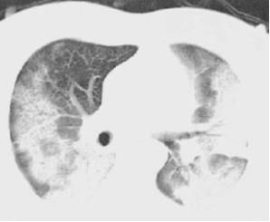蝶翼征是间质性肺水肿的表现吗,肺蝶翼征