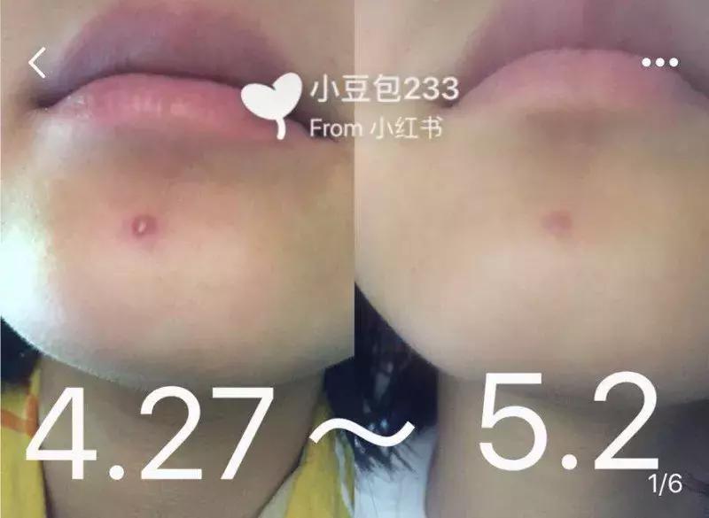 亲试十大祛痘药,亲测各类祛痘印护肤品