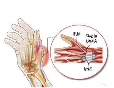 腱鞘炎晨僵怎么治疗,一招解决腱鞘炎晨僵