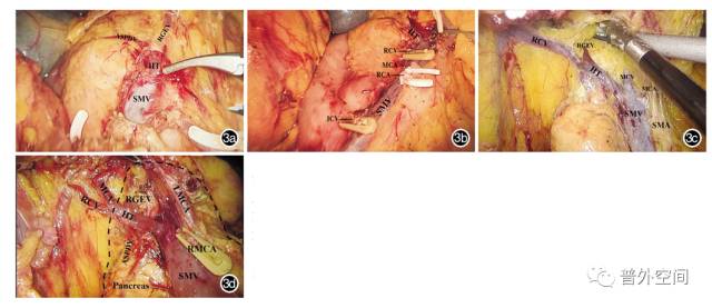 腹腔镜右半结肠癌手术步骤,腹腔镜右半结肠癌根治术术后护理