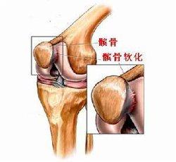 髌骨软骨软化的康复方法