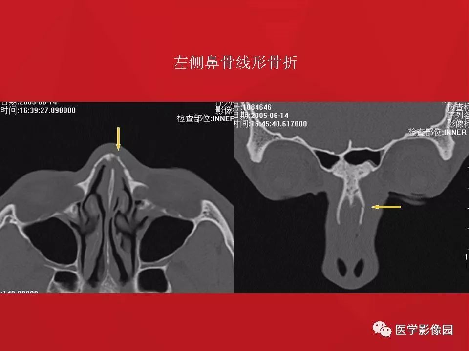 左侧鼻骨骨折伴鼻中隔骨折,双侧鼻骨及左上颌骨突骨折