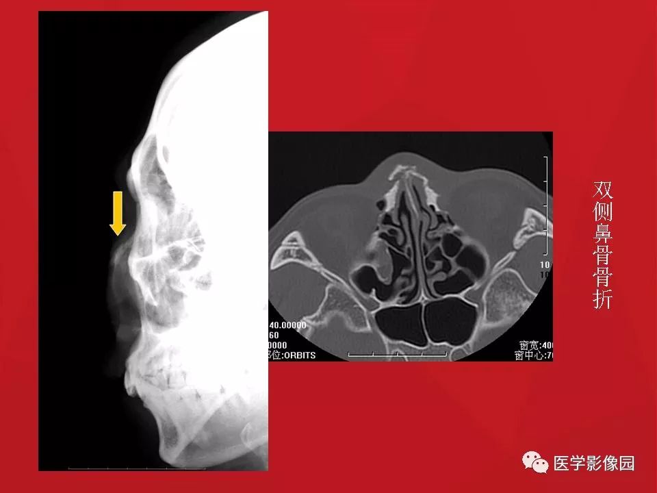 左侧鼻骨骨折伴鼻中隔骨折,双侧鼻骨及左上颌骨突骨折
