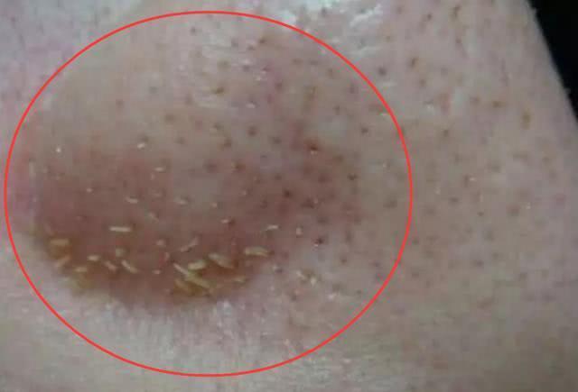 挤挤挤！鼻子挤出“小黄虫”,竟全是它的粪便，记住2方法排光它