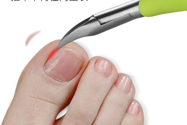 脚指甲长到肉里面怎么剪,脚指甲长到里面去了怎么剪