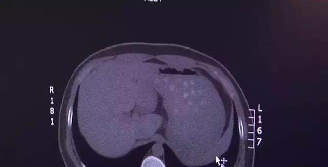 高中生肚子疼到吐是什么原因,高中生经常腹痛是怎么回事