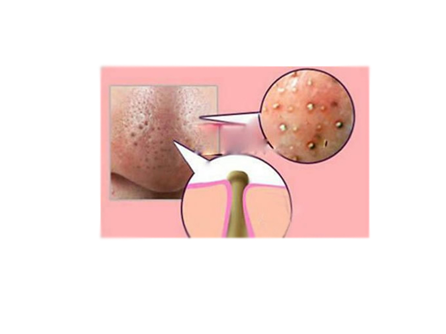 洗鼻子洗出白色絮状粘稠分泌物,鼻子上的白色分泌物用什么药