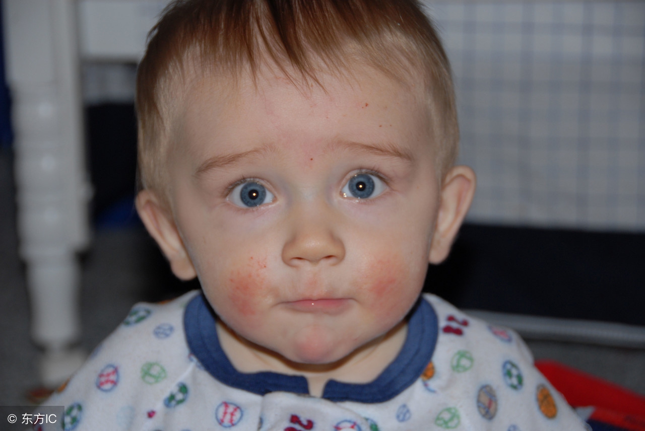 新生儿宝宝湿疹怎么护理最有效,新生儿湿疹宝妈们用什么治好的