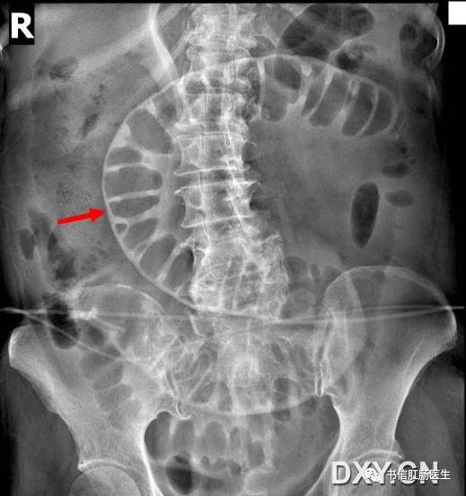 10种经典肠道影像征象：绳征、串珠征、螺纹征……你听过几个？