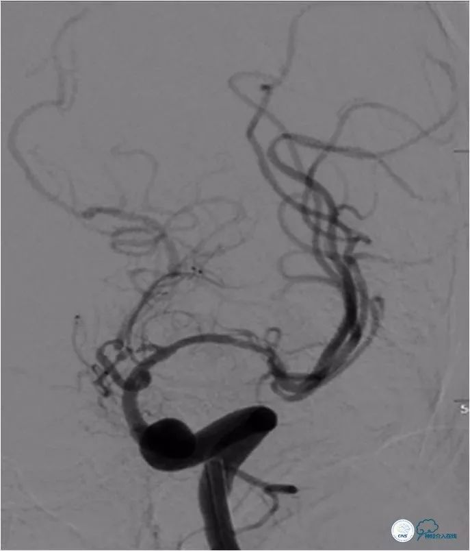 大脑中动脉支架术后再狭窄的几率,天坛医院介入脑血管手术