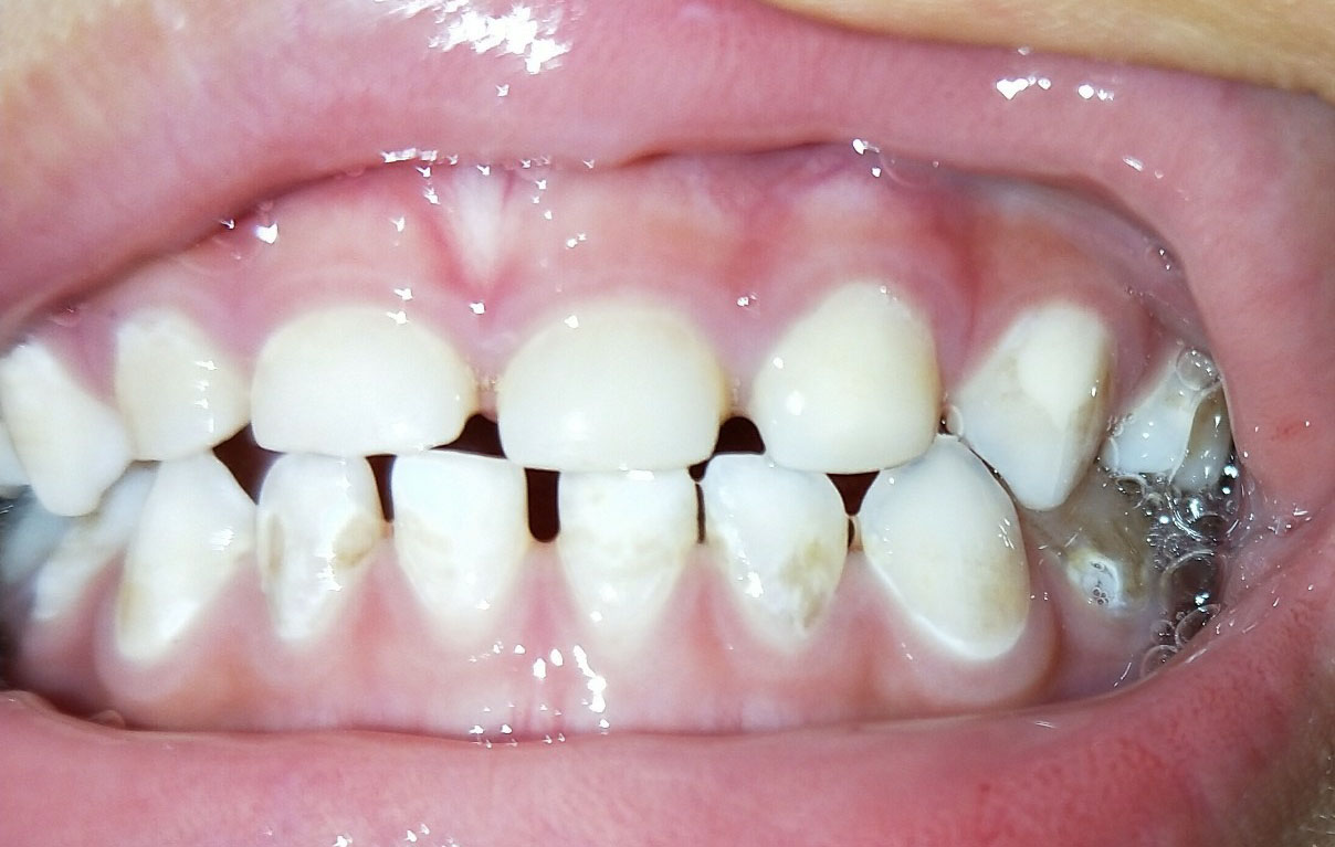 宝宝补牙全过程实操,宝宝束缚式补牙过程